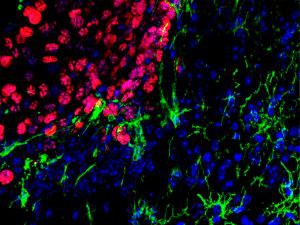 Investigadores desarrollan nueva estrategia para frenar metástasis cerebrales en melanoma